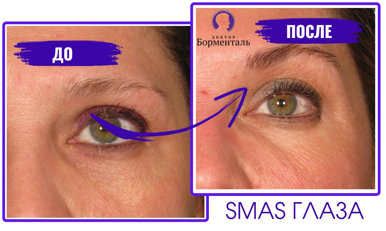 SMAS-лифтинг глаза
